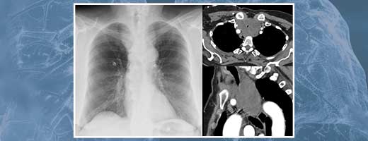 Central airway obstruction