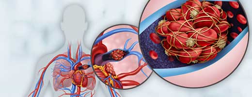 venous thromboembolism