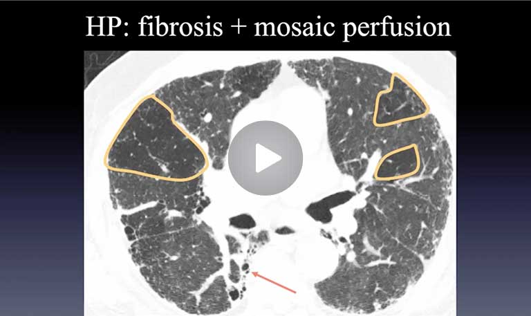 Hypersensitivity Pneumonitis (HP)