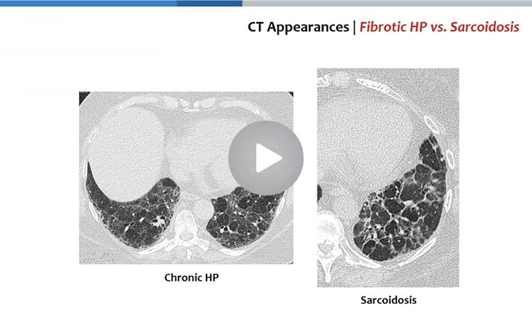 Imaging in Sarcoidosis