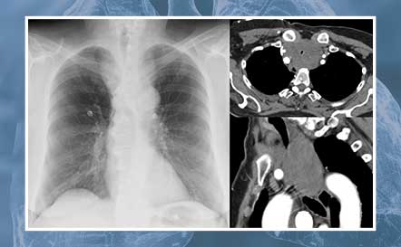 Central Airway Obstruction