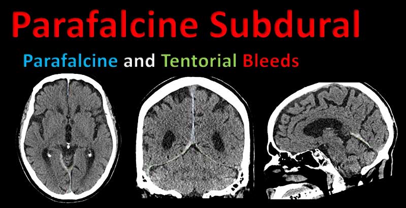 Screening for Potentially Life-Threatening Pathology on Non-Contrast Head CT for the Intensivist