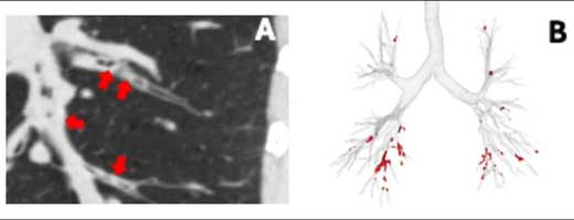 Cilia damage from cigarette smoke