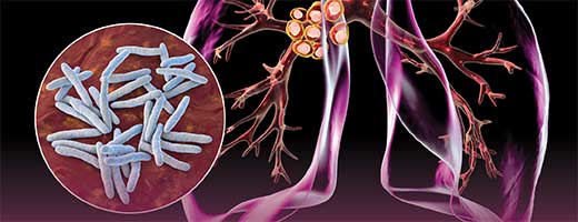 An artistic rendering of lungs with TB