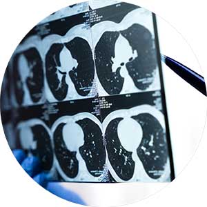 CT scans of lungs