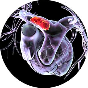 Right-sided pulmonary embolism