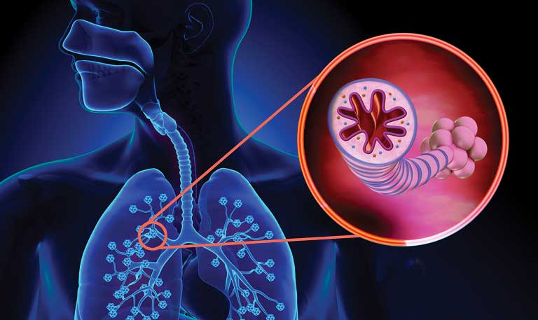 asthma in the lungs
